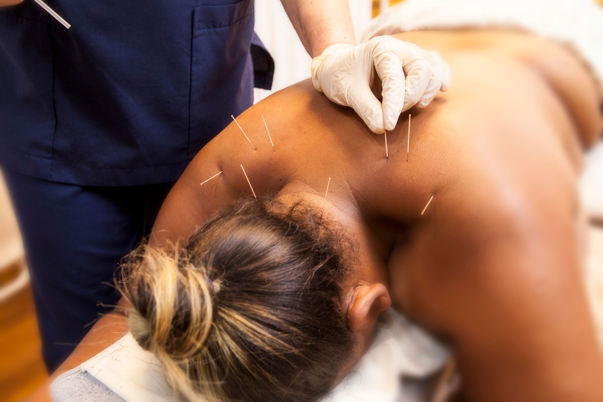 A physiotherapist treating a woman with dry needling therapy. The photograph is close-up and the depth of field is very shallow.