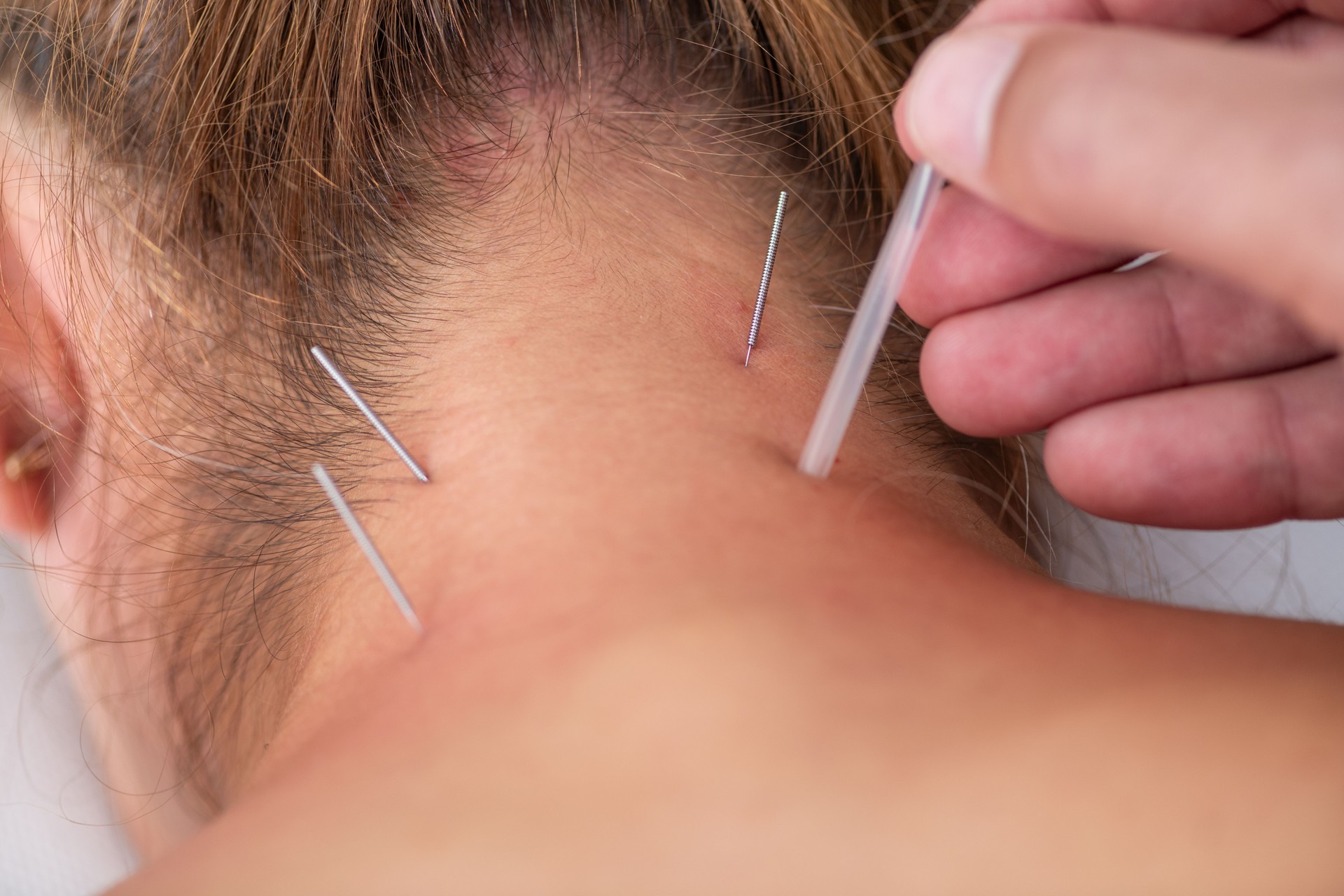 A physical therapist performs dry needling on a patients neck to alleviate muscle tension. The patient lies face down on a therapy table, receiving precise needle placement for targeted relief