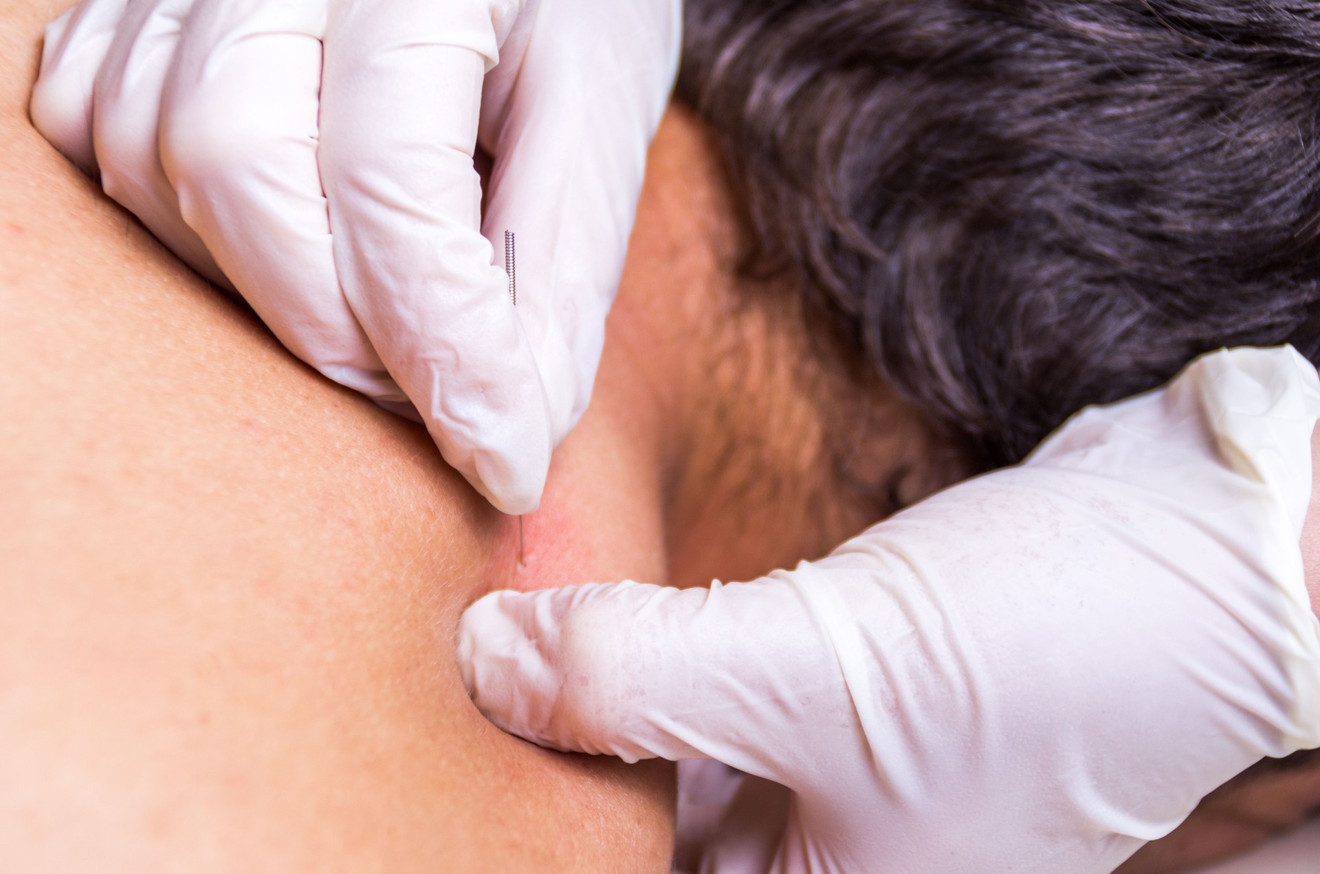 puncion seca dry needling acupunture fisio therapy