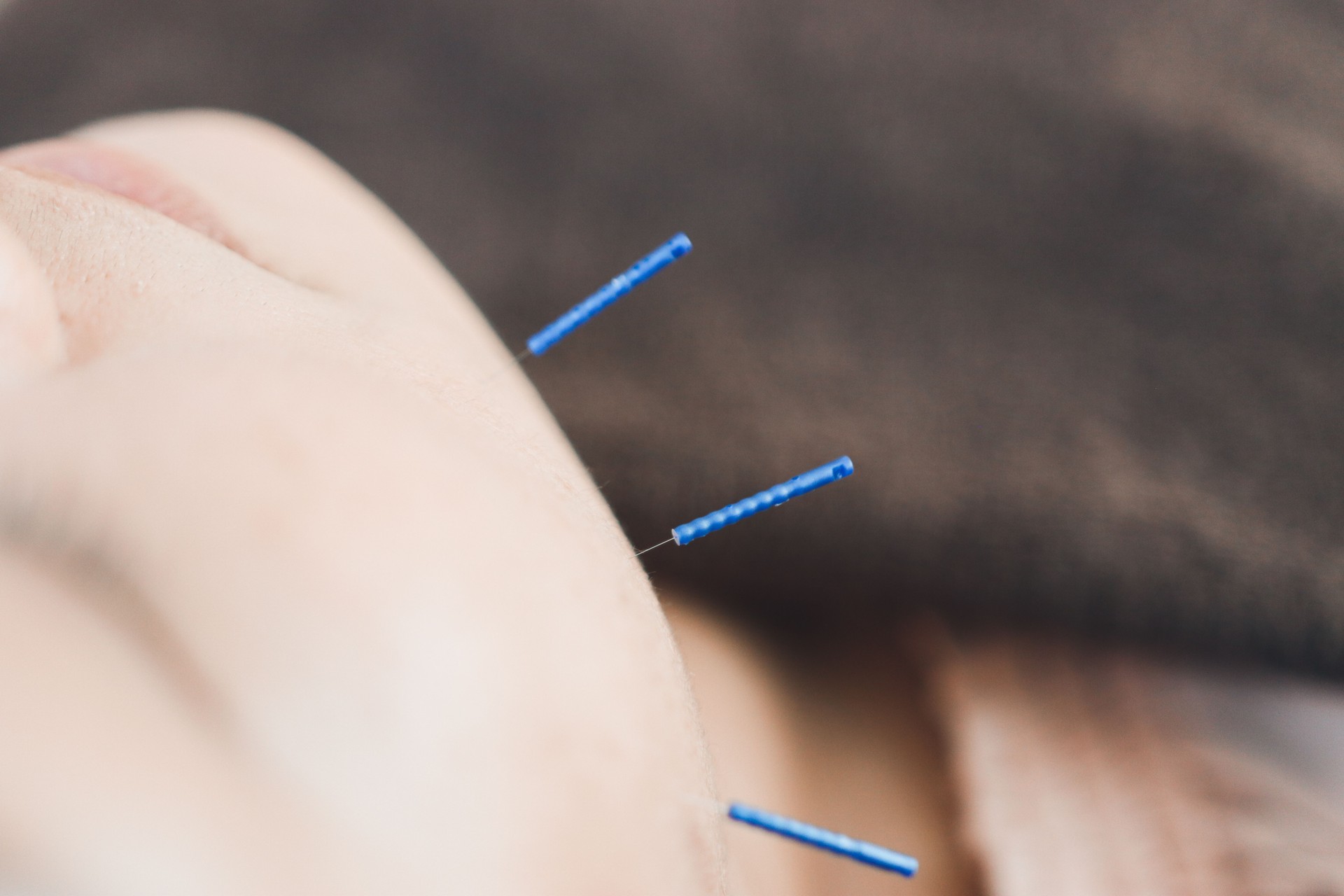 Facial cosmetic acupuncture for female in Asia