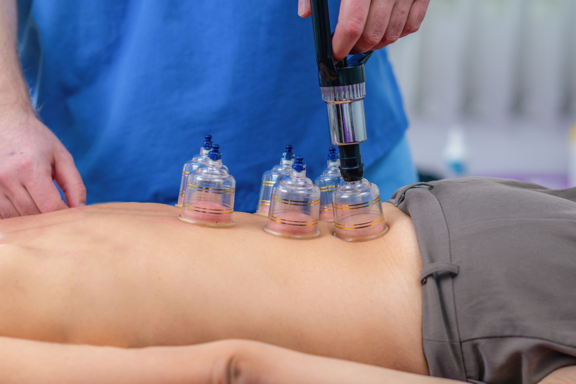 Woman receiving cupping therapy on her back during a physical therapy session. The suction cups help relieve muscle tension, improve circulation, and promote pain relief and relaxation.